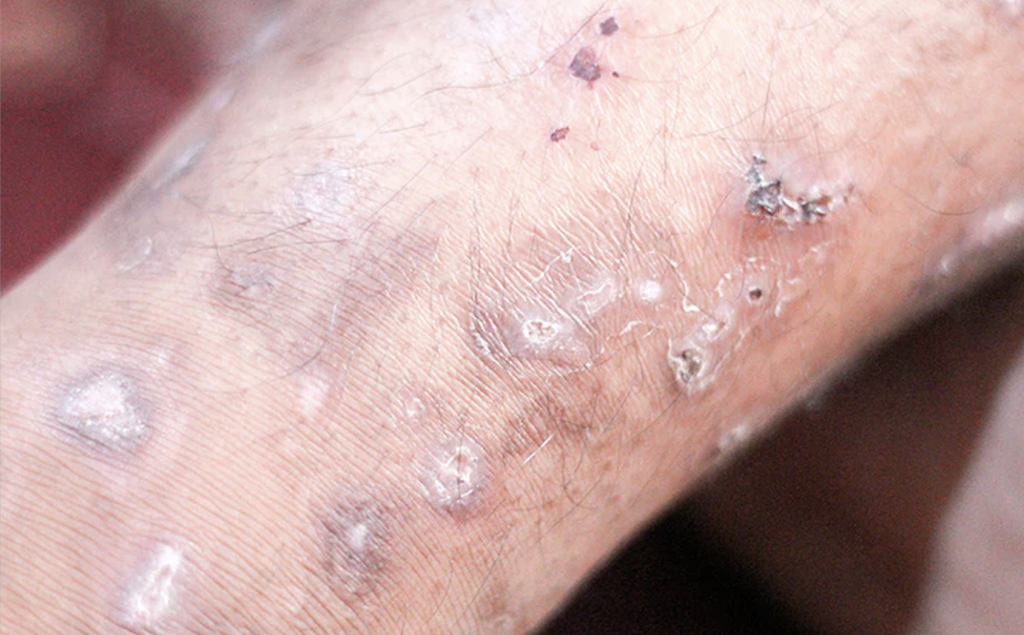 Skin Infection